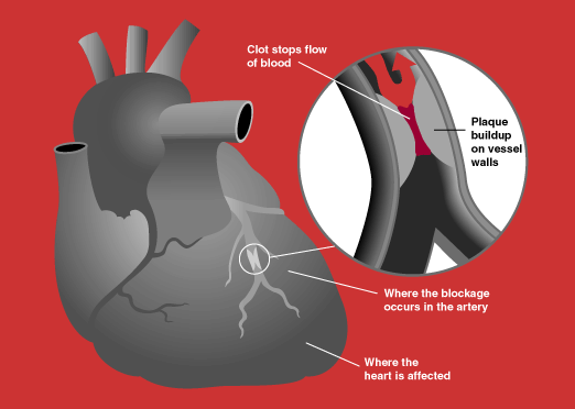 Acute-Coronary-Syndrome.png
